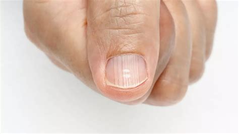 Health Problems Your Fingernails Can Indicate From White Spots To Ridges Mirror Online