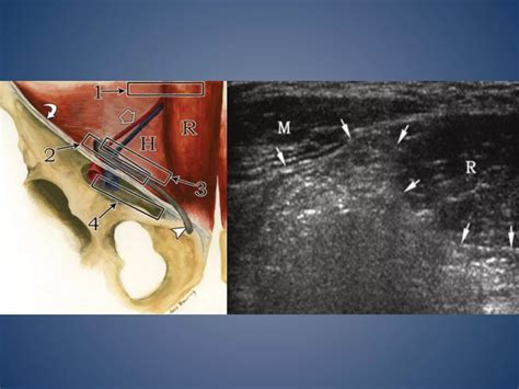 Imaging Of Inguino Scrotal Region PPT