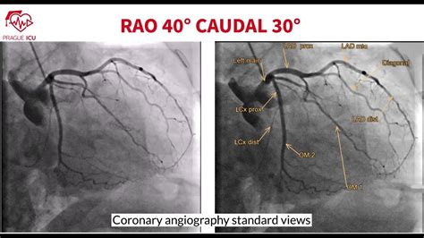 Coronary Angiography Standard Views Youtube