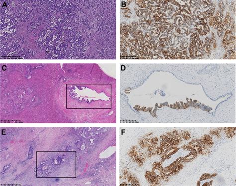 Claudin18 2 Expression And Its Clinicopathological Feature In