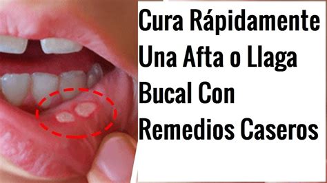 Cura Rápidamente Una Afta O Llaga Bucal Con Remedios Caseros Youtube