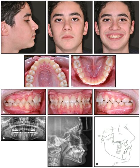 Space Closure In Lateral Incisor Agenesis Using Tads