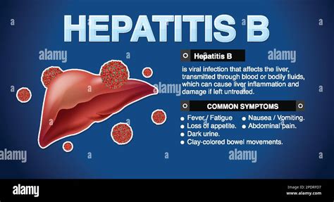 Symptoms Of Hepatitis B Infographic Illustration Stock Vector Image