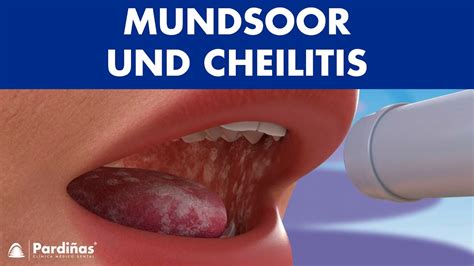 Mundsoor Wie Man Candidiasis Und Andere Pilz Im Mund Heilt Youtube