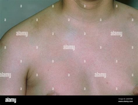 Dislocated Collar Bone Shoulder Of A Man Aged 20 Showing A Dislocated Right Collar Bone