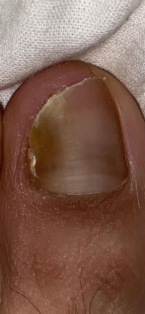 Has My Nail Fungus Advanced Too Far For Topical Treatment I Want To