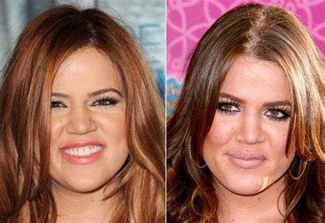 Khloe Kardashian before and after plastic surgery 09 – Celebrity plastic surgery online