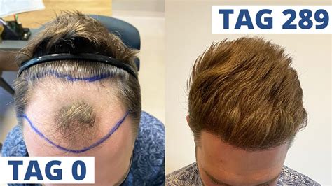 Haartransplantation Vorher Nachher Zeitraffer Sekunden Monat