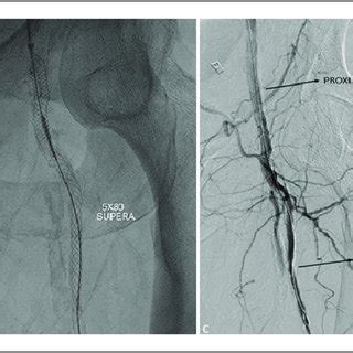 Summary of Common Femoral Artery Stenting Studies. | Download ...