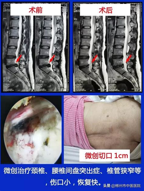 【談骨論筋 】 脊柱微創 為患者「撐腰」 每日頭條