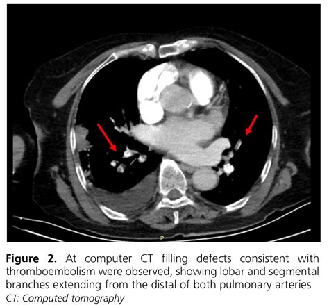 Potential Failure Of Novel Generation Oral Anticoagulants In Preventing