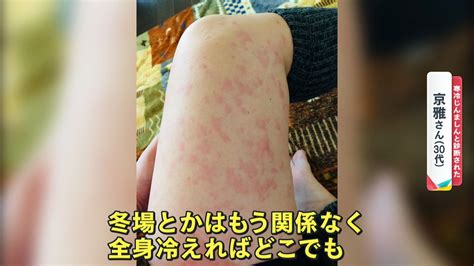 腫れとかゆみが襲う「寒冷じんましん」患者数去年比1 5倍2歳児の発症ケースも めざましmedia