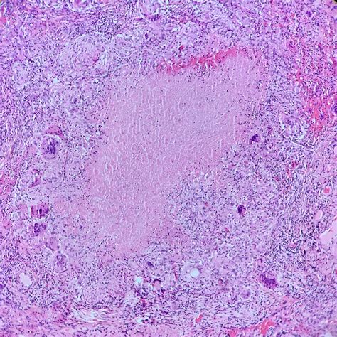 Pathology Outlines Tuberculosis