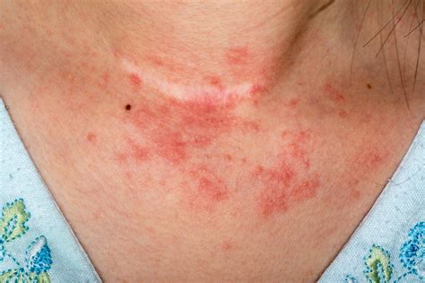 Contact Dermatitis Signs Symptoms And Complications