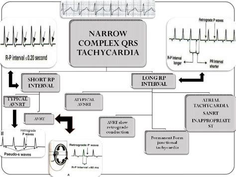 Narrow Qrs Tachycardia