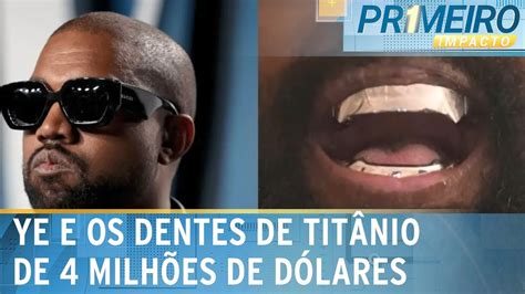 Kanye West Gasta R 4 Mi Para Colocar Prótese De Titânio Nos Dentes