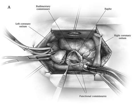 Repair Of The Bicuspid Aortic Valve Operative Techniques In Thoracic And Cardiovascular Surgery