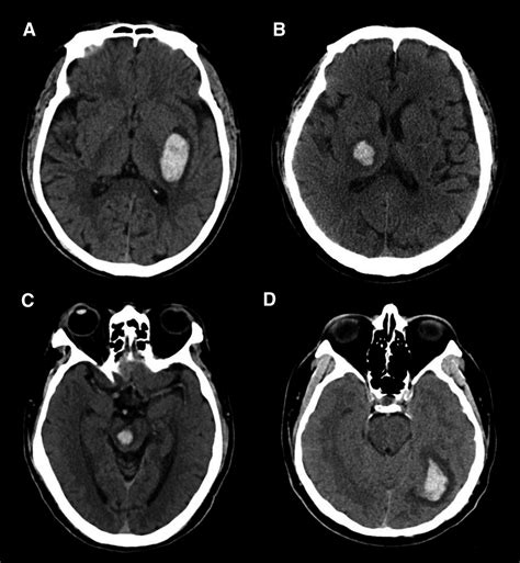 Intracranial Hematoma