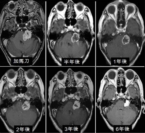 加馬刀手術