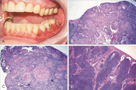 Clinical And Histological Features Of Gingival Squamous Cell Carcinoma