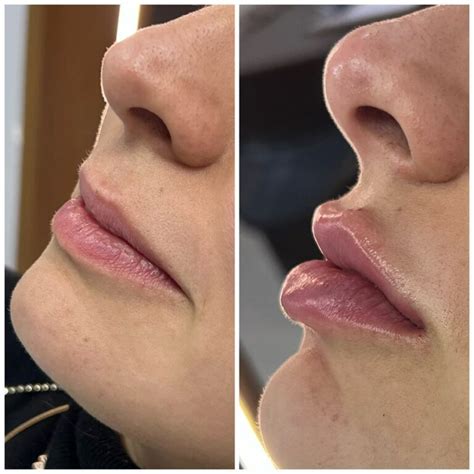 Preenchimento Labial Antes E Depois