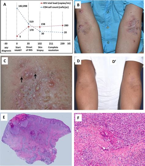 A Clinical Course And Serial Change Of CD4 Count And Viral Load B