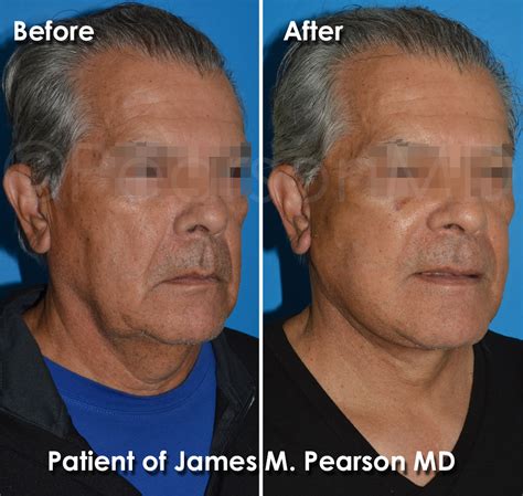 Plastic Surgery For Men Dr James Pearson Facial Plastic Surgery