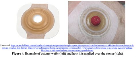 Ostomy complications: ED presentations, complications, and management ...