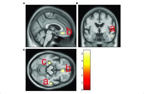 Gray Matter Volume Decrease In The Right Middle Temporal Gyrus A