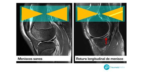 S Ntomas De Una Rotura De Menisco Traumatopedia