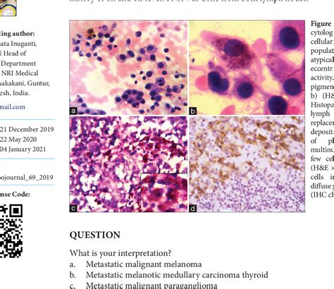 Figure 1 From Diagnosis Of A Rare Case Of Malignant Metastatic Tumor On