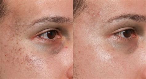 Treating Nevus Of Ota With Picosure Pro