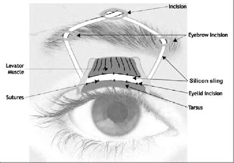 Five Year Follow Up Of A Month Trial Of Stability Of Silicone Band