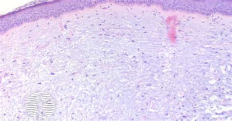 Dermnet Focal Mucinosis Figure Image