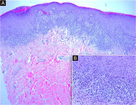 A Histological Sections Show An Epidermis With Orthokeratotic