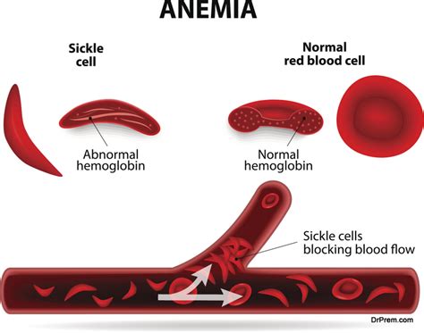 Sickle Cell Anemia Ncp