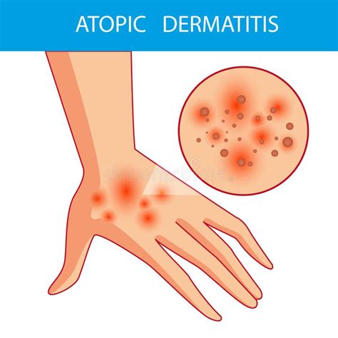 Eczema Atópica Da Dermatite Atópica Fatores Que Causam a Doença C