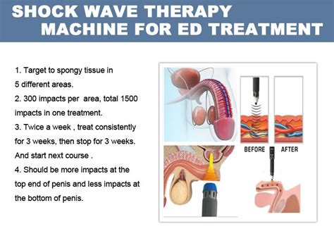 Best Portable Shockwave Therapy Machine For Ed Soking