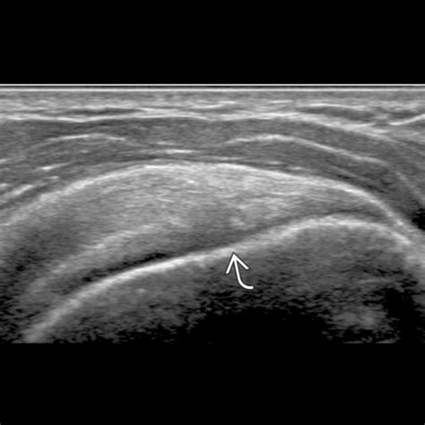 Shoulder Ultrasound Anatomy