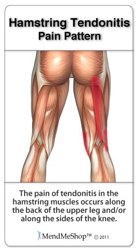 Tendinopathy Of The Hamstring