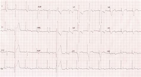 Ecg In Cardiac Resynchronization Therapy Crt All About