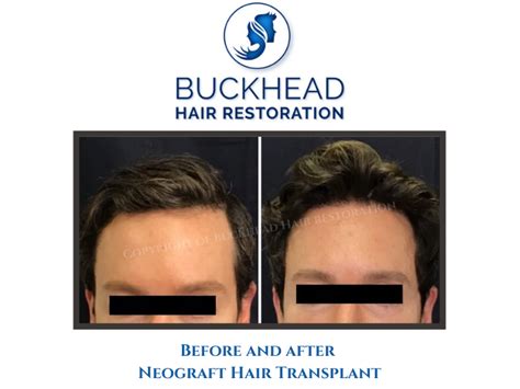 Before And After Neograft Hair Transplant Buckhead Hair Restoration