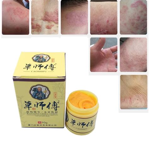 Effective Herbal Ointment Dermatitis Psoriasis Eczema Cream Anti Itch