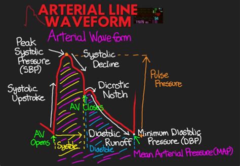 Hemodynamic Monitoring Flashcards Quizlet