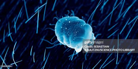 Scabies Mite On Human Skin Illustration High-Res Vector Graphic - Getty ...