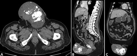 Computed Tomographic Images Showing A Large Left Paratesticular Tumor