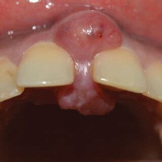 (a) and (b) Dumbbell-shaped swelling involving the buccal and palatal... | Download Scientific ...