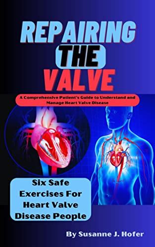 Repairing The Valve A Comprehensive Patient S Guide To Understand And