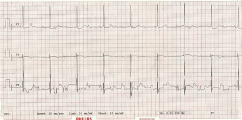 Journal Of Postgraduate Gynecology And Obstetrics Congenital Heart Block