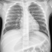 Admission Chest X Ray Demonstrating Elevation Of The Right